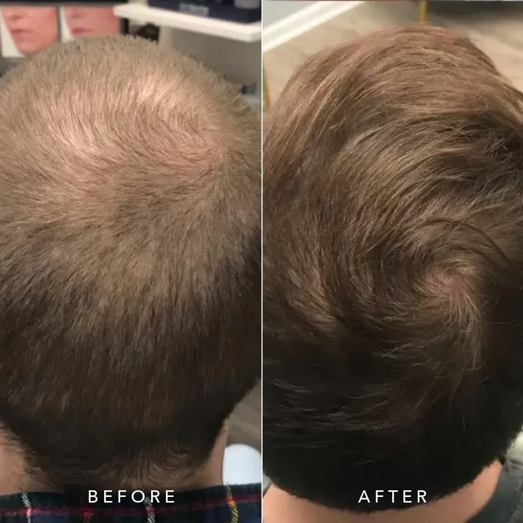Male Vertex and Crown Hair Density Regrowth Before and After Charlottesville VA