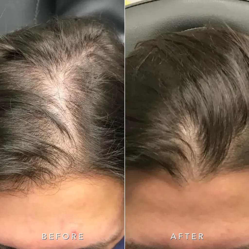 Female Hairline and Widening Part Restoration Before and After