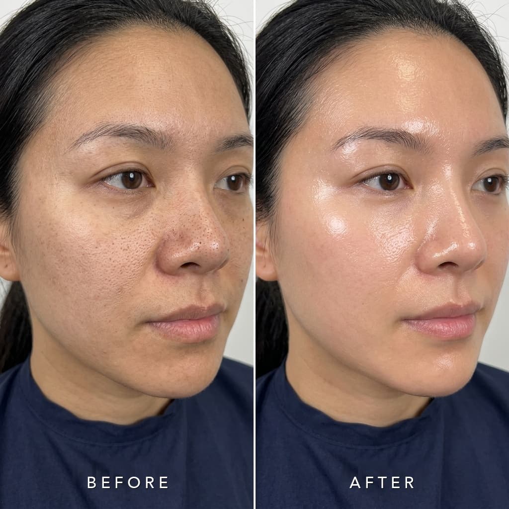 Hydrafacial Treatment Before and After by Master Esthetician