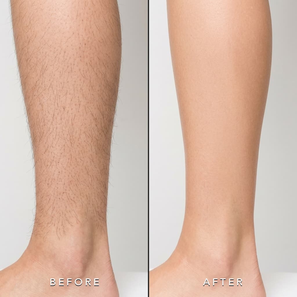Leg Hair Removal Before and After by Master Esthetician in Charlottesville VA